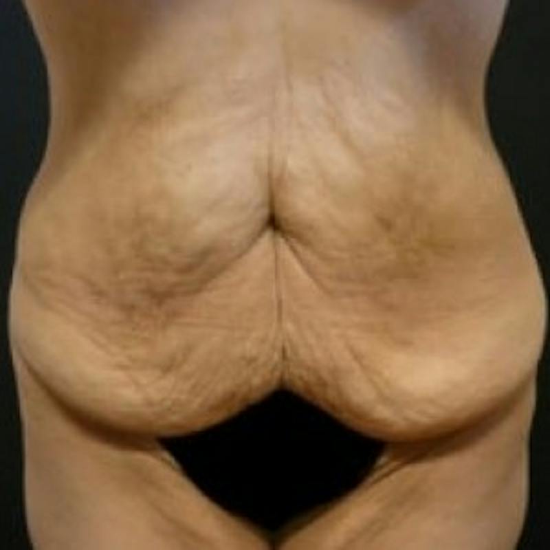 Abdominoplasty (Tummy Tuck) Before & After Gallery - Patient 275913 - Image 1