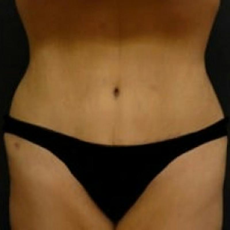 Abdominoplasty (Tummy Tuck) Before & After Gallery - Patient 275913 - Image 2