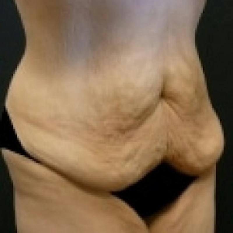 Abdominoplasty (Tummy Tuck) Before & After Gallery - Patient 275913 - Image 3