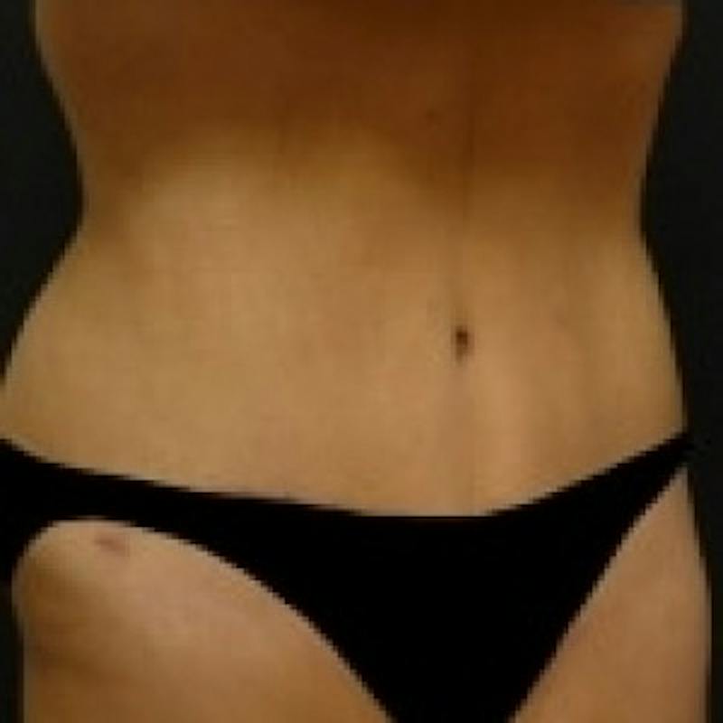 Abdominoplasty (Tummy Tuck) Before & After Gallery - Patient 275913 - Image 4