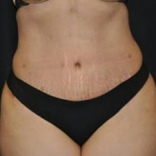 Abdominoplasty (Tummy Tuck) Before & After Gallery - Patient 188696 - Image 2