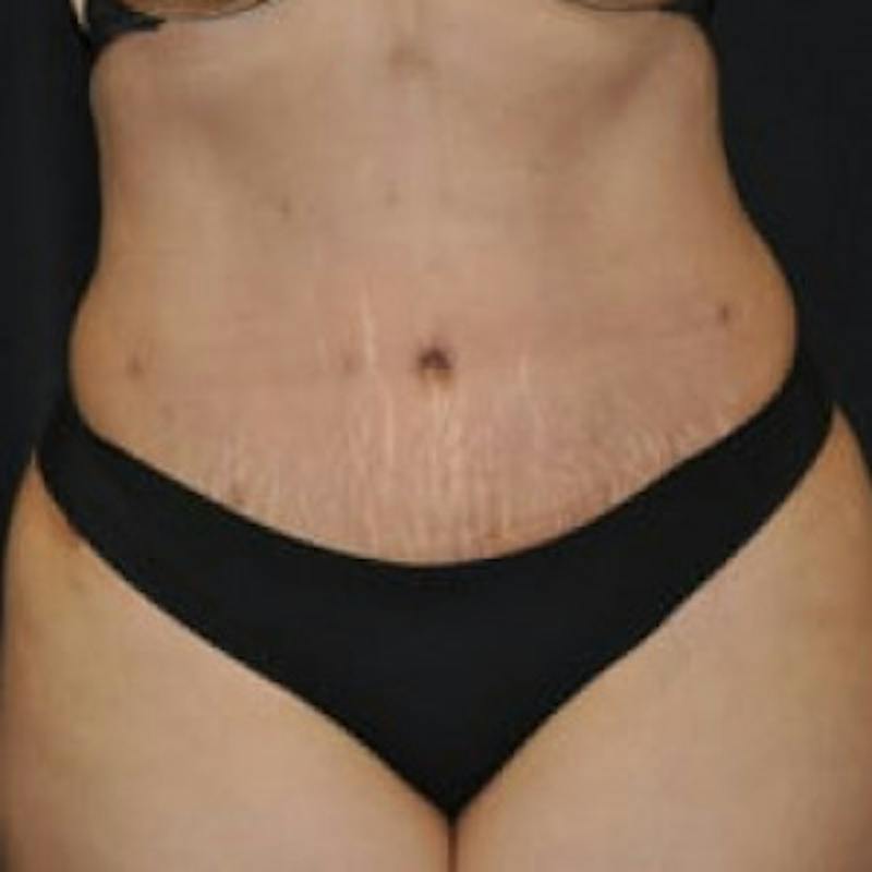 Abdominoplasty (Tummy Tuck) Before & After Gallery - Patient 188696 - Image 2