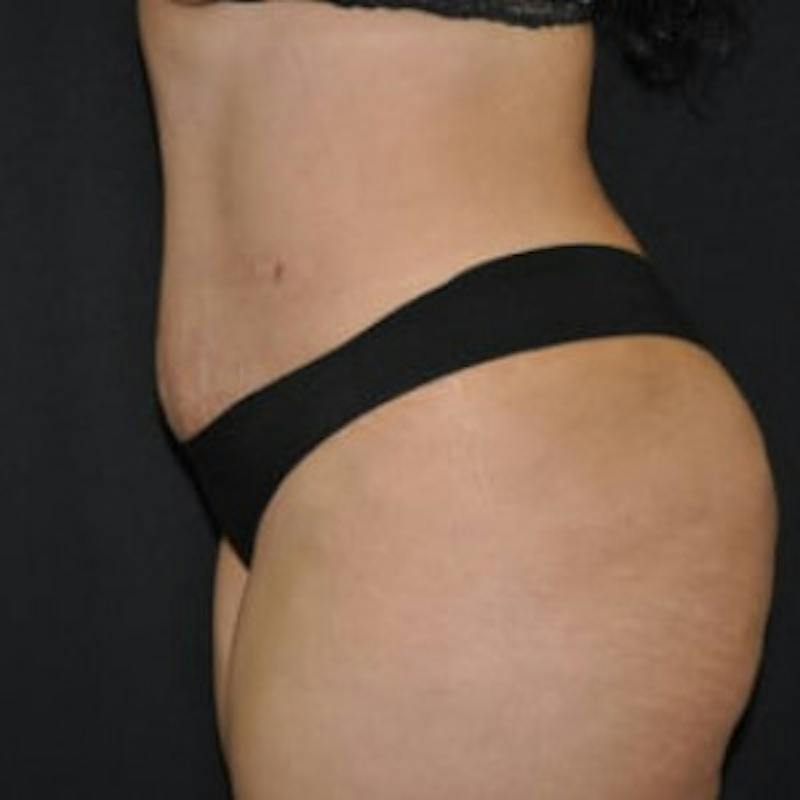 Abdominoplasty (Tummy Tuck) Before & After Gallery - Patient 188696 - Image 4