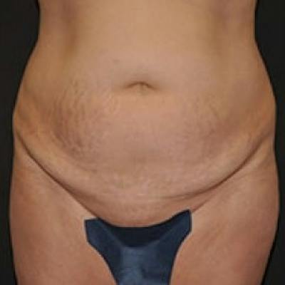 Abdominoplasty (Tummy Tuck) Before & After Gallery - Patient 255956 - Image 1