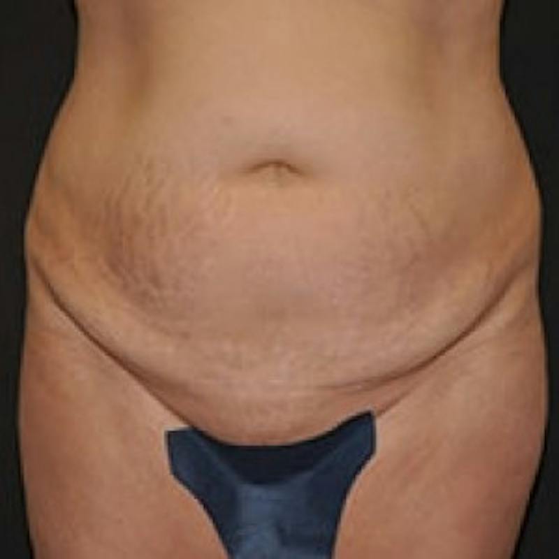 Abdominoplasty (Tummy Tuck) Before & After Gallery - Patient 255956 - Image 1