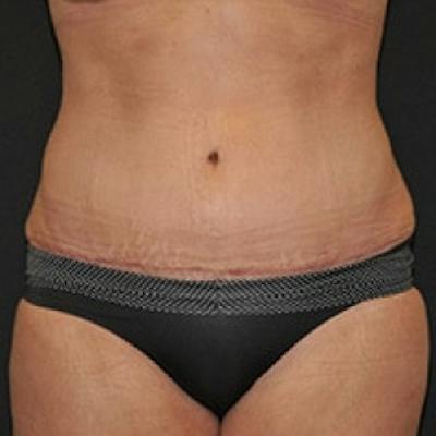 Abdominoplasty (Tummy Tuck) Before & After Gallery - Patient 255956 - Image 2