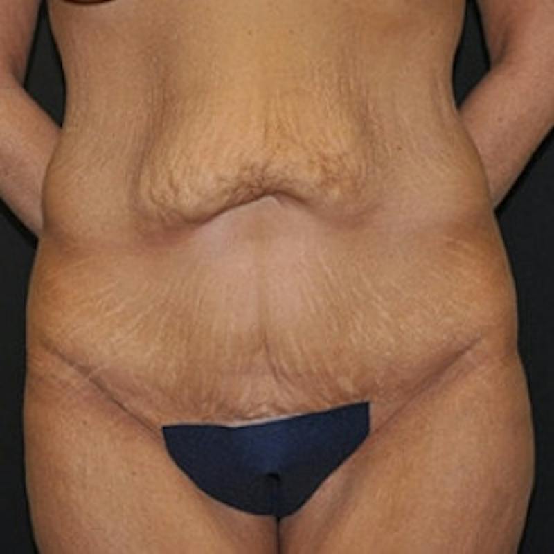 Abdominoplasty (Tummy Tuck) Before & After Gallery - Patient 954093 - Image 1