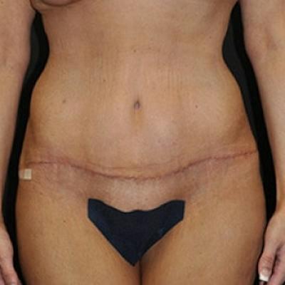 Abdominoplasty (Tummy Tuck) Before & After Gallery - Patient 954093 - Image 2