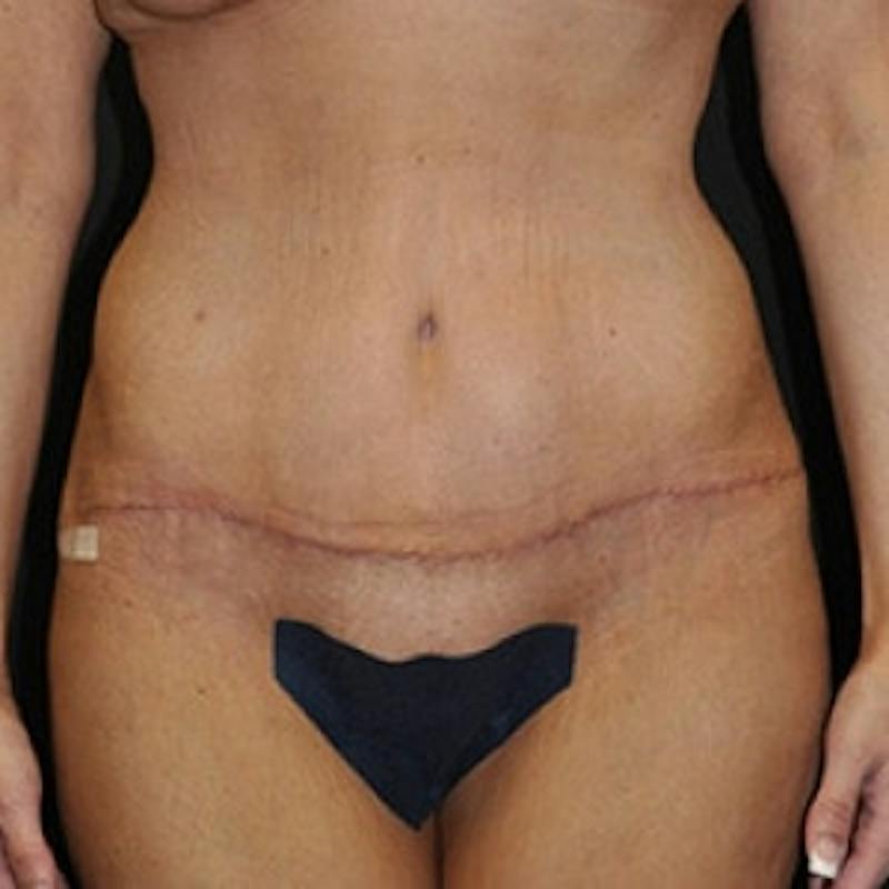 Abdominoplasty (Tummy Tuck) Before & After Gallery - Patient 954093 - Image 2