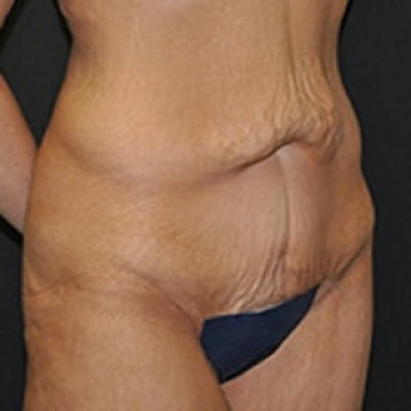 Abdominoplasty (Tummy Tuck) Before & After Gallery - Patient 954093 - Image 3