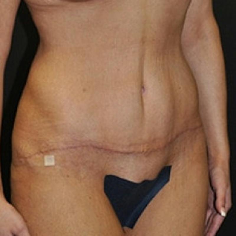 Abdominoplasty (Tummy Tuck) Before & After Gallery - Patient 954093 - Image 4