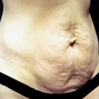 Abdominoplasty (Tummy Tuck) Before & After Gallery - Patient 422301 - Image 1