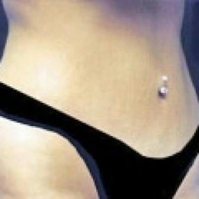 Abdominoplasty (Tummy Tuck) Before & After Gallery - Patient 422301 - Image 2