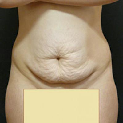 Abdominoplasty (Tummy Tuck) Before & After Gallery - Patient 381679 - Image 1