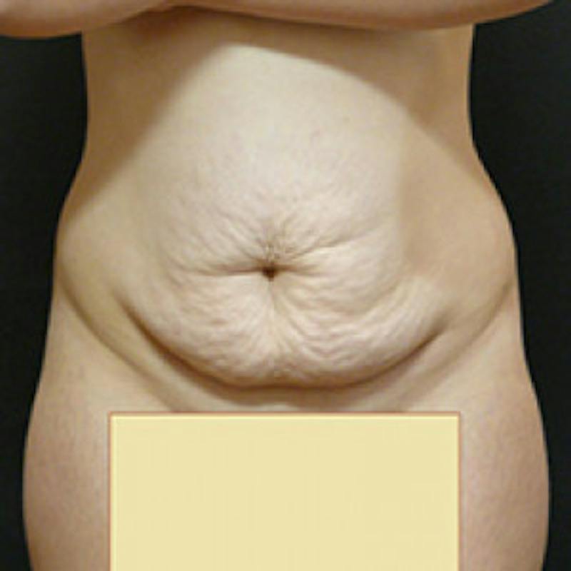 Abdominoplasty (Tummy Tuck) Before & After Gallery - Patient 381679 - Image 1