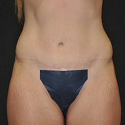 Abdominoplasty (Tummy Tuck) Before & After Gallery - Patient 381679 - Image 2
