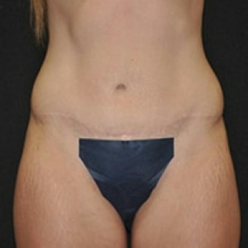 Abdominoplasty (Tummy Tuck) Before & After Gallery - Patient 381679 - Image 2