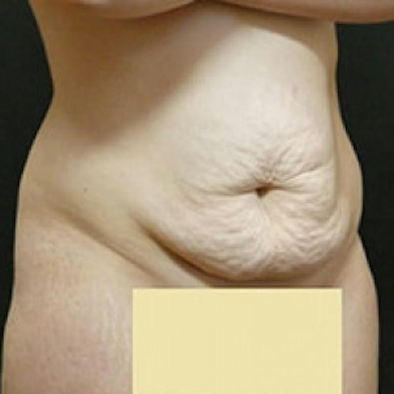 Abdominoplasty (Tummy Tuck) Before & After Gallery - Patient 381679 - Image 3