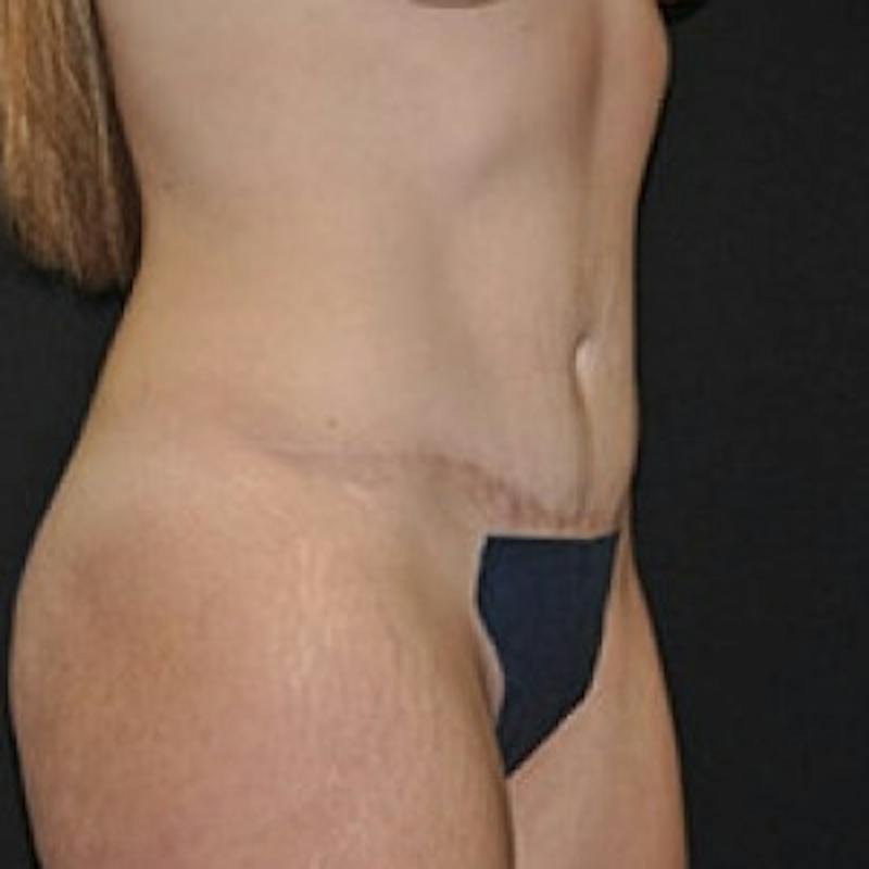 Abdominoplasty (Tummy Tuck) Before & After Gallery - Patient 381679 - Image 4