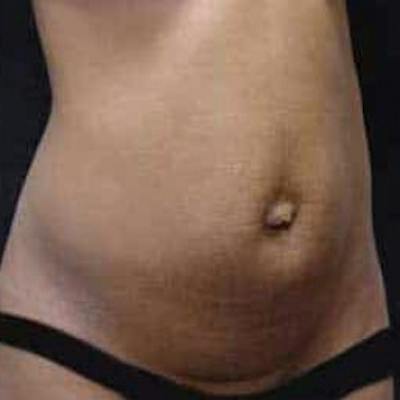 Abdominoplasty (Tummy Tuck) Before & After Gallery - Patient 143683 - Image 1