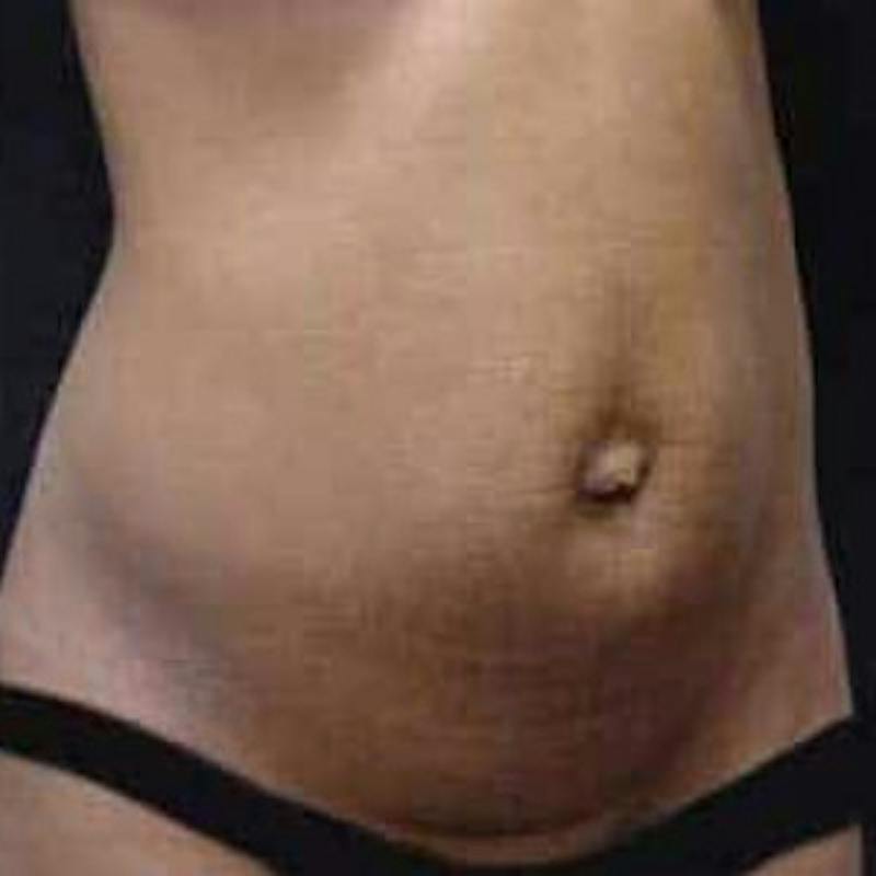 Abdominoplasty (Tummy Tuck) Before & After Gallery - Patient 143683 - Image 1