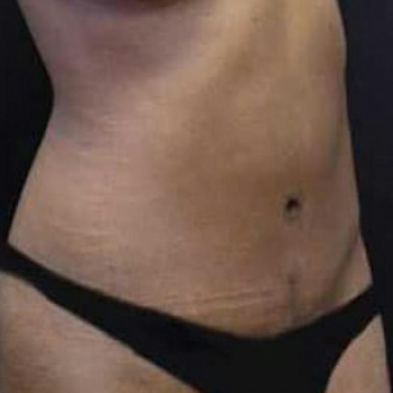 Abdominoplasty (Tummy Tuck) Before & After Gallery - Patient 143683 - Image 2