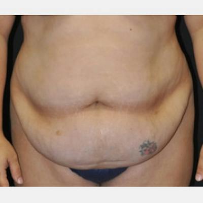Abdominoplasty (Tummy Tuck) Before & After Gallery - Patient 372973 - Image 1
