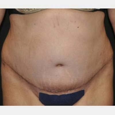 Abdominoplasty (Tummy Tuck) Before & After Gallery - Patient 372973 - Image 2