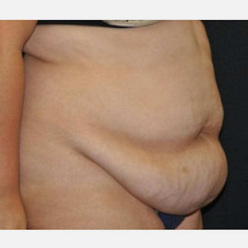 Abdominoplasty (Tummy Tuck) Before & After Gallery - Patient 372973 - Image 3