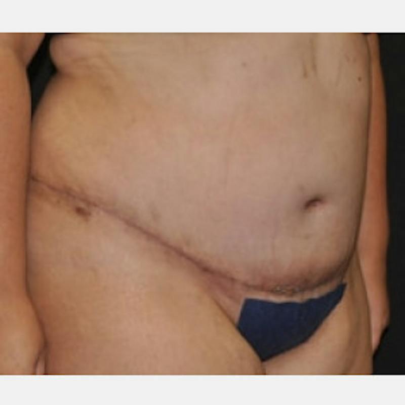 Abdominoplasty (Tummy Tuck) Before & After Gallery - Patient 372973 - Image 4