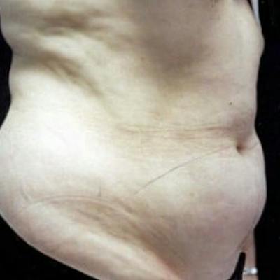 Abdominoplasty (Tummy Tuck) Before & After Gallery - Patient 198179 - Image 1