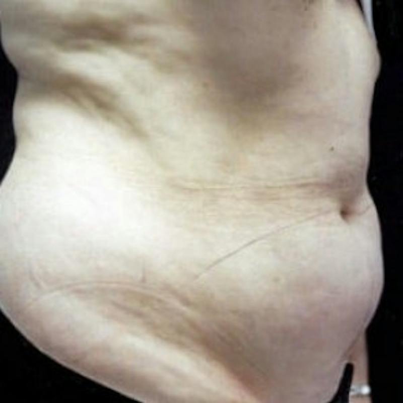 Abdominoplasty (Tummy Tuck) Before & After Gallery - Patient 198179 - Image 1