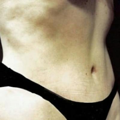 Abdominoplasty (Tummy Tuck) Before & After Gallery - Patient 198179 - Image 2