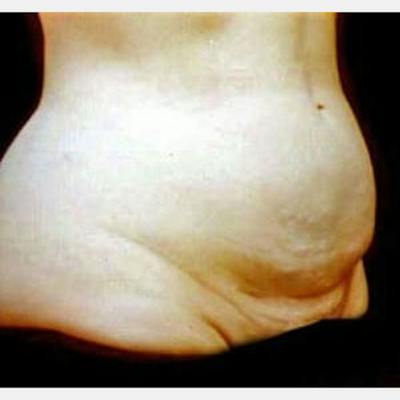 Abdominoplasty (Tummy Tuck) Before & After Gallery - Patient 299177 - Image 1