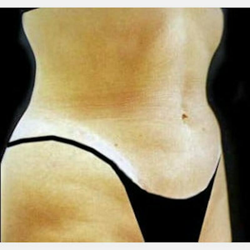 Abdominoplasty (Tummy Tuck) Before & After Gallery - Patient 299177 - Image 2
