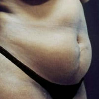 Abdominoplasty (Tummy Tuck) Before & After Gallery - Patient 242910 - Image 1