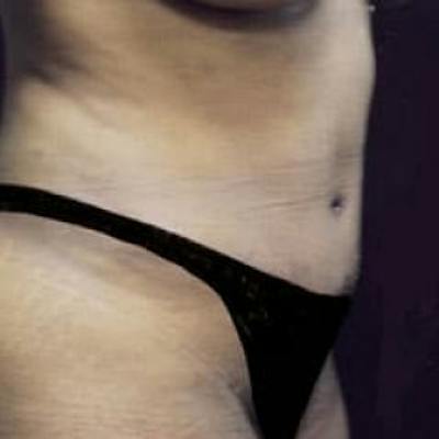 Abdominoplasty (Tummy Tuck) Before & After Gallery - Patient 242910 - Image 2