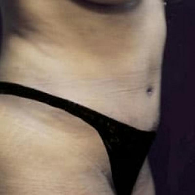 Abdominoplasty (Tummy Tuck) Before & After Gallery - Patient 242910 - Image 2
