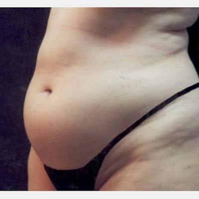 Abdominoplasty (Tummy Tuck) Before & After Gallery - Patient 468488 - Image 1