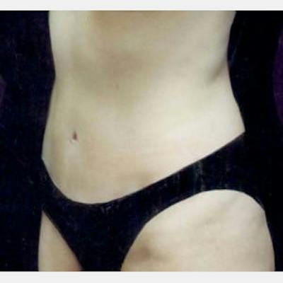 Abdominoplasty (Tummy Tuck) Before & After Gallery - Patient 468488 - Image 2