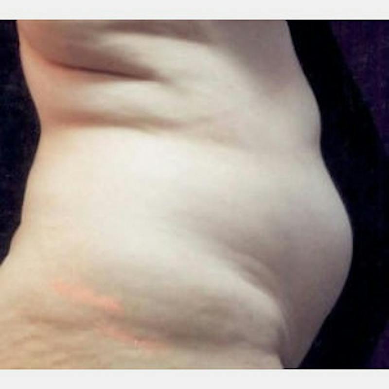 Abdominoplasty (Tummy Tuck) Before & After Gallery - Patient 468488 - Image 3