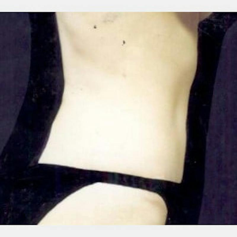 Abdominoplasty (Tummy Tuck) Before & After Gallery - Patient 468488 - Image 4