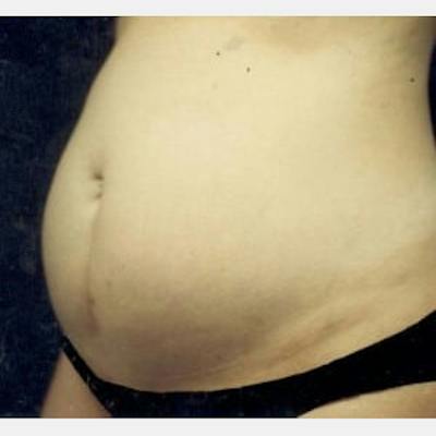 Abdominoplasty (Tummy Tuck) Before & After Gallery - Patient 321781 - Image 1