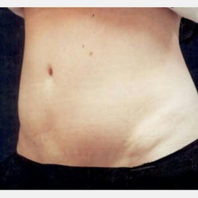 Abdominoplasty (Tummy Tuck) Before & After Gallery - Patient 321781 - Image 2