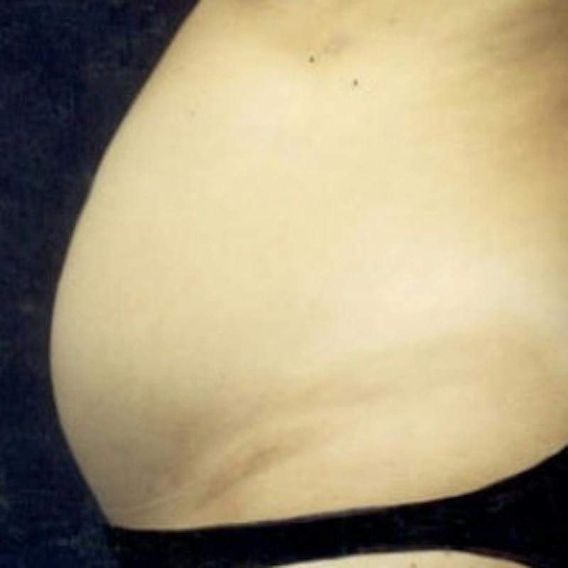 Abdominoplasty (Tummy Tuck) Before & After Gallery - Patient 321781 - Image 3