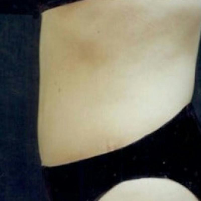 Abdominoplasty (Tummy Tuck) Before & After Gallery - Patient 321781 - Image 4