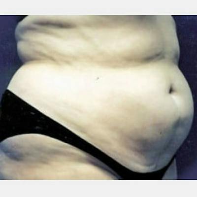 Abdominoplasty (Tummy Tuck) Before & After Gallery - Patient 304872 - Image 1