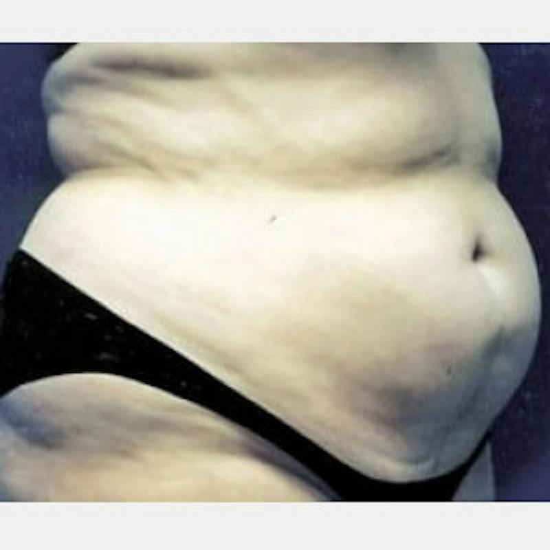 Abdominoplasty (Tummy Tuck) Before & After Gallery - Patient 304872 - Image 1