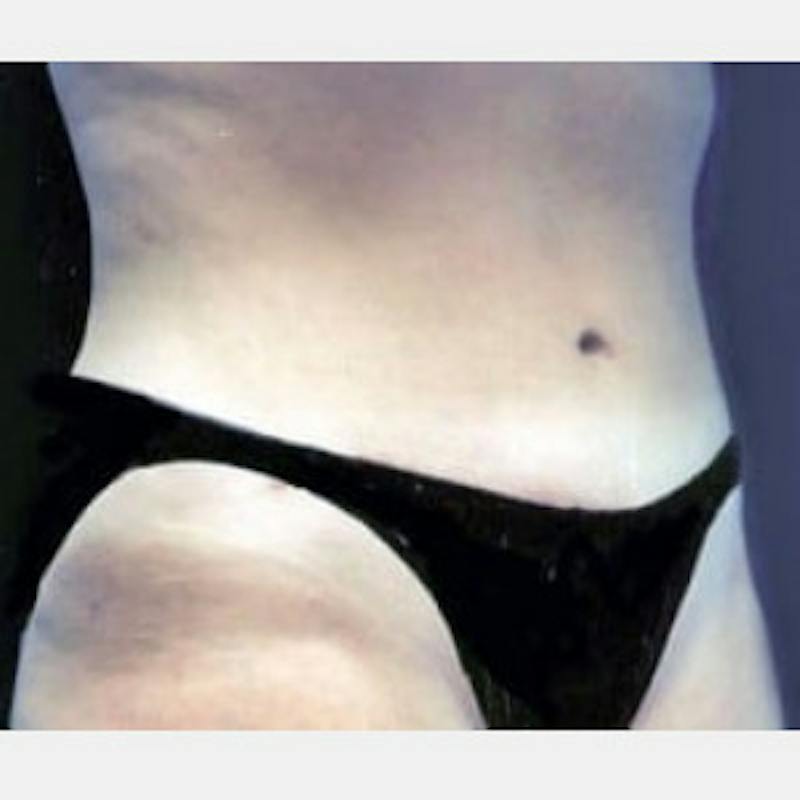 Abdominoplasty (Tummy Tuck) Before & After Gallery - Patient 304872 - Image 2