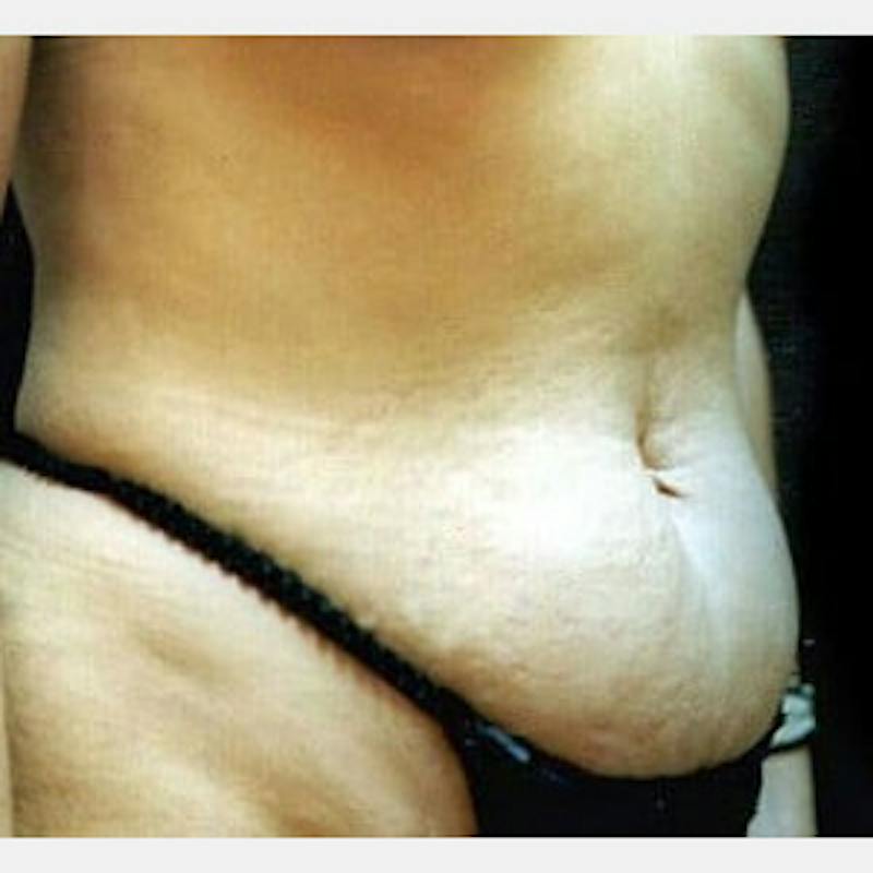 Abdominoplasty (Tummy Tuck) Before & After Gallery - Patient 419985 - Image 1